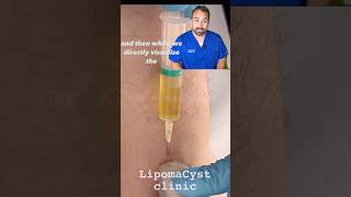 Bakers Cyst drainage under ultrasound [upl. by Mehala74]