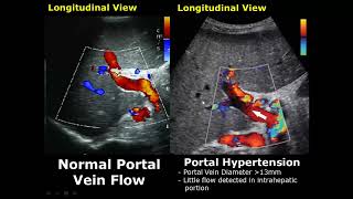 Liver Ultrasound Normal Vs Abnormal Image Appearances Comparison  Liver Pathologies USG [upl. by Angelle]