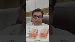 Subcision RF Treatment For Acne Scars  Acne Scar Treatments [upl. by Accemahs433]