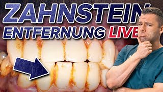 Zahnsteinentfernung LIVE  So läuft es ab Trotz Angst Zahnstein loswerden ✅ [upl. by Alur]