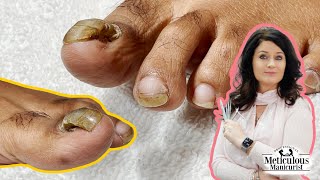 Tutorial on How to Care amp Treat a Detached Toenail with a Pedicure [upl. by Gabey952]