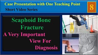 Scaphoid Bone Fracture Case Presentation with One Teaching Point [upl. by Tessler]