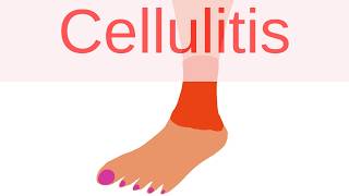 What is Cellulitis  Pathology mini tutorials [upl. by Auqinimod]