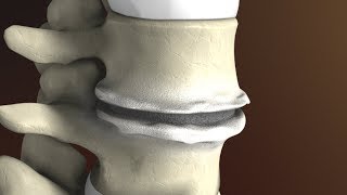 Degenerative Disc Disease Spondylosis explained by Spine Surgeon Dr Jessica Shellock Plano TX [upl. by Gladys]