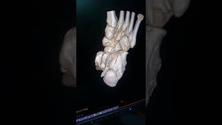 Calcaneal fracture orthopedics shortvideo [upl. by Nytsua]