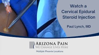 Head or Neck Pain A Cervical Epidural Steroid Injection May Help Watch it Live [upl. by Ylla]