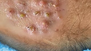 Big Cystic Acne Blackheads Extraction Blackheads amp Milia Whiteheads Removal Pimple Popping 059 [upl. by Meri216]