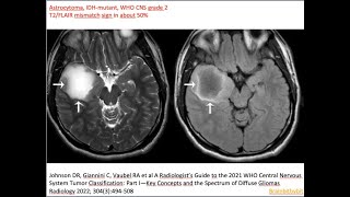 61 Astrocytoma IDHmutant grade 2 amp 3 diffuse amp anaplastic astrocytoma IDH oncometabolite [upl. by Selokcin]