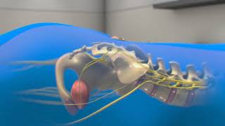 Neuspera Sacral Neuromodulation System for Urinary Urgency Incontinence UUI  3D animation [upl. by Garfield316]