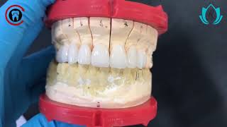 Porcelain Fused To Zirconia  IPS Emax Veneers [upl. by Roybn]