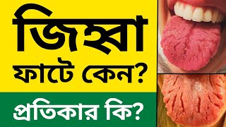 জিহ্বা ফাটে কেন জিহ্বা ফাটার কারণ ও প্রতিকার  Fissured tongue [upl. by Analim]