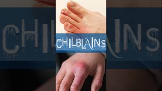 How to avoid Chilblains shorts [upl. by Corell347]