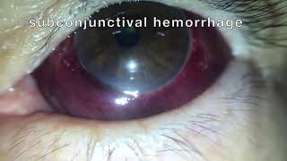 Subconjunctival hemorrhage hyposphagma [upl. by Yaf]