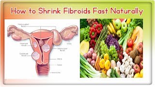 How to Shrink Fibroids Fast Naturally [upl. by Saimon]