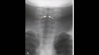 Bacterial tracheitis [upl. by Lenej]