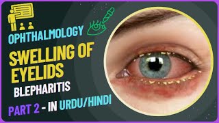 Understanding the Swelling of Eyelids A Comprehensive Lecture on Blepharitis [upl. by Hume]