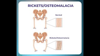 What is the Vitamin Deficiency in Osteomalacia Vitamin D Deficiency [upl. by Hazeefah470]