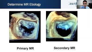 Joint Echo Conference Structural Heart Mitral Valve Intervention [upl. by Amlez]