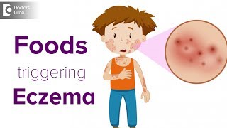 Foods triggering eczema flare up  Help your child avoid the itch  Dr Udhay Sidhu [upl. by Helga]