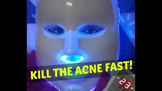 Get Rid of Acne Scar with Blue Led Light Therapy [upl. by Isis]