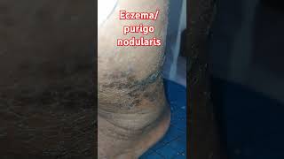 EczemaPurigo nodularis skincare visit Anm Herbal Health and skincare clinic Lucknow [upl. by Haimorej]