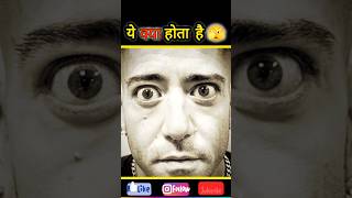 Exophthalmos 👀🤔 hyperthyroidismfuturedr shorts trending ytshorts neet facts yt tiktok 😱 [upl. by Yramanna]