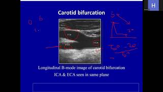 carotid Doppler ultrasound amp renal Doppler ultrasoundleap training [upl. by Ley971]