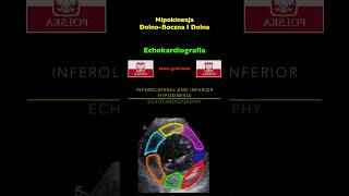 Echokardiografia  Hipokinezja DolnoBoczna I Dolna [upl. by Eutnoj]