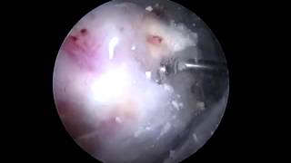 Arthroscopic Surgery for Calcific Tendonitis [upl. by Nad]