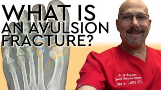 What is an Avulsion Fracture AND How to Splint One [upl. by Mcknight]