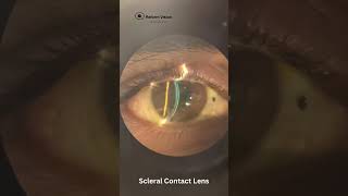 Contact Lens Fitting in Keratoconus  RGP Lenses  Rose K2 Lenses  Scleral Lenses  Hyderabad [upl. by Danie]