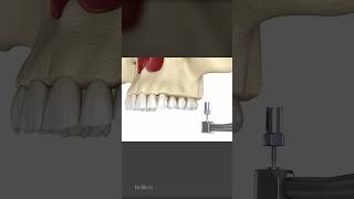 Sinus Lift Surgery Frontal Access [upl. by Mok827]