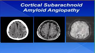 Cortical Subarachnoid Hemorrhage by Sebastian Koch MD [upl. by Onid]