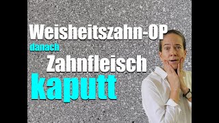 WeisheitszahnOP Zahnfleisch hängt jetzt FALSCH am ZAHN [upl. by Pharaoh]