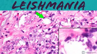 Leishmaniasis Leishmania Infection 5Minute Pathology Pearls ‪Dermatology Dermatopathology [upl. by Nesnaj]