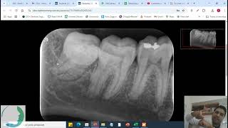 PauRenFreAlv  Exodontia dos Sisos com Biomaterial [upl. by Etnoled]