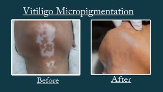 Best Skin Colour matching micropigmentation for Vitiligo white patches For enquiry call 9700020802 [upl. by Eemla939]