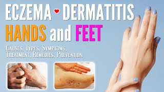 Eczema on Hands and Feet Causes Symptoms Types Treatment Remedies Prevention  Dermatitis treat [upl. by Genesia49]