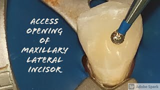 Maxillary Lateral Incisor Access Opening [upl. by Robena]