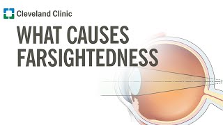 What Causes Farsightedness [upl. by Wan]