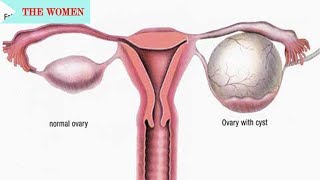 Explained Ruptured ovarian cyst SIGNS and SYMPTOMS [upl. by Cynarra]