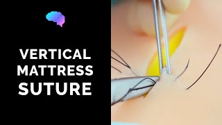 Vertical Mattress Suture  OSCE Guide  UKMLA  CPSA [upl. by Leahcimed]