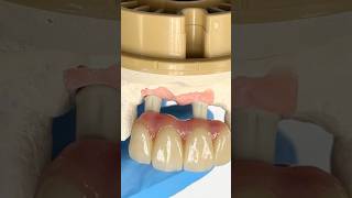 Anterior Zirconia Bridge lsk121shorts dental teeth [upl. by Aihsyt]