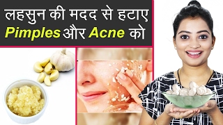 लहसुन की मदद से हटाए पिम्पल्स और एक्ने को  How to Remove Pimples and Acne Using Garlic  Pimples [upl. by Ymor]