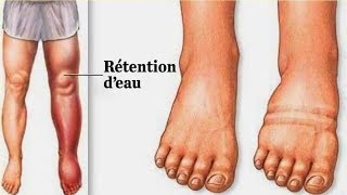 Rétention d’eau  en voici la cause et comment dégonfler les pieds et les jambes naturellement [upl. by Calendra]