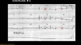 1215 Lead ECG Exercise  3 [upl. by Nolek]