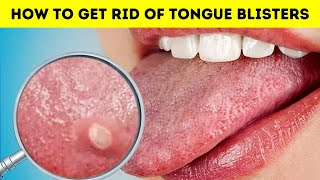 How to get rid of tongue blisters canker sore on your tongue fast at home [upl. by Otreblif]