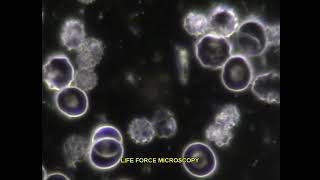 LIVE BLOOD ANALYSIS ECHINOCYTES BURR CELLS [upl. by Cris]