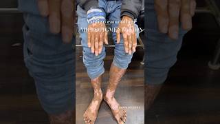 100 VITILIGO camouflage micropigmentation  vitiligo tattoo coverup  vitiligo cures  SAFEDDAAG [upl. by Gnex]