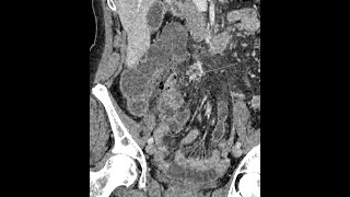 Appendicitis  perforated  complicated  appendicoliths present [upl. by Ramey656]